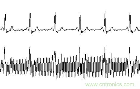 采用MSP430設(shè)計(jì)的12位心電(ECG)放大器